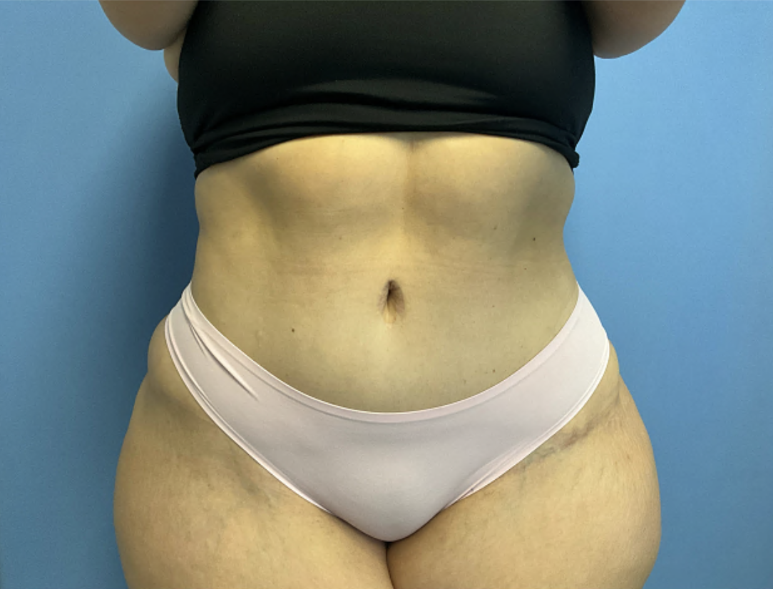 Tummy-Tuck--Case-Study-2951 | After Body